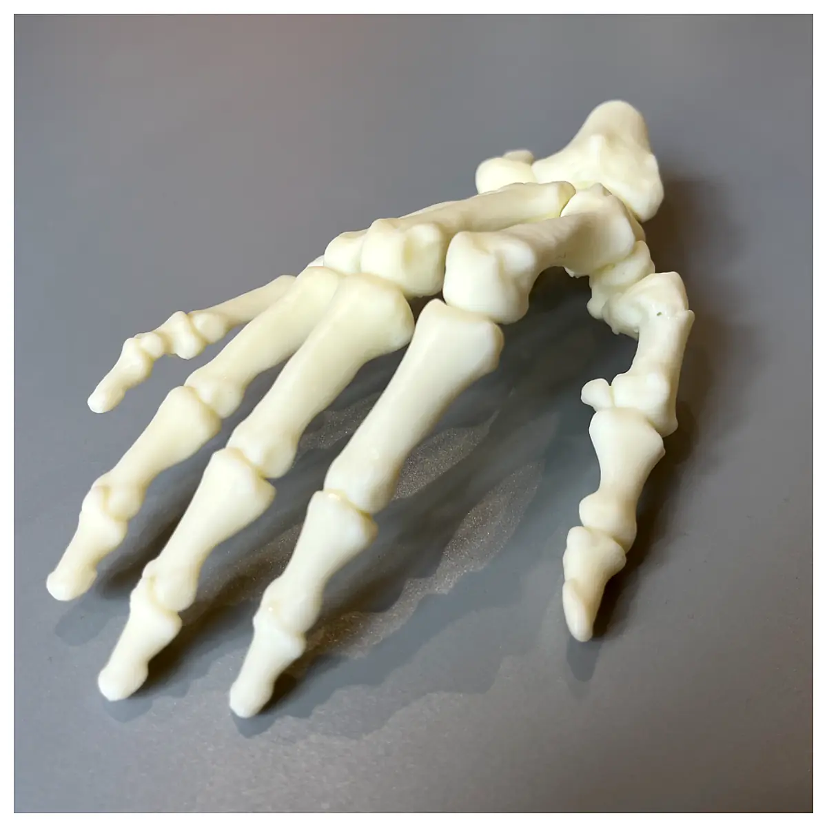 Metacarpal Fracture Treatment Fracture Repair Techniques Post Fracture Rehabilitation Carpal Bone Recovery Carpal Pain Relief