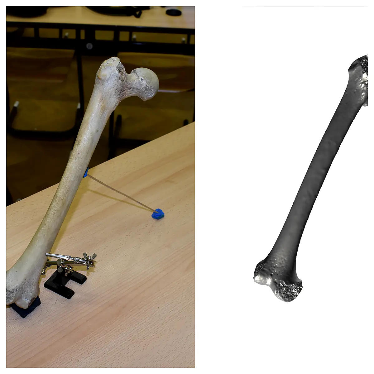 Thigh Bone Scan Diagnosis Imaging Fracture Detection Bone Health Femur Scan