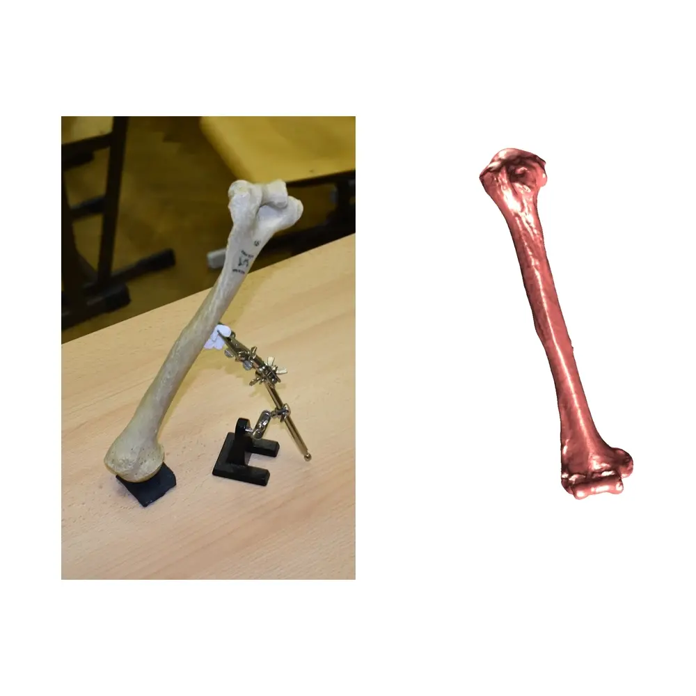 Elbow Bone Scan Arm Scanner Bone Scan Measurement Diagnosis Exercise Bone Analysis Bone Health